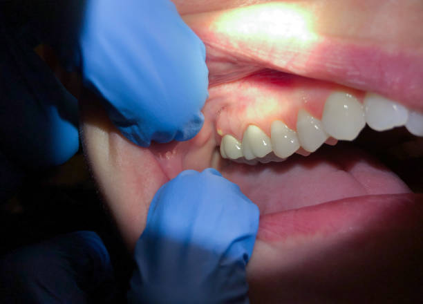 Best Emergency Tooth Extraction in Franklin, KY