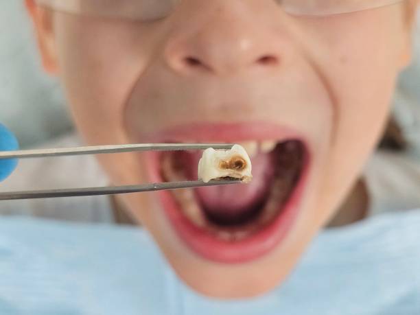 Best Emergency Wisdom Teeth Removal in Franklin, KY